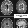 Расшифровка МРТ головного мозга: снимки здорового человека, с опухолью, пороками развития